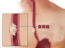老年食管癌