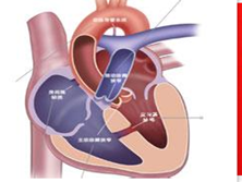 小儿先天性主动脉瓣狭窄
