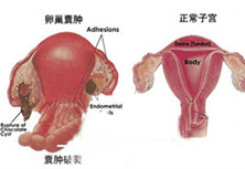 卵巢巧克力囊肿破裂