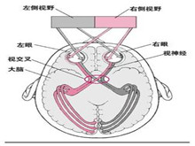 压迫性视神经病变