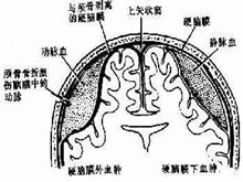 硬脑膜下脓肿